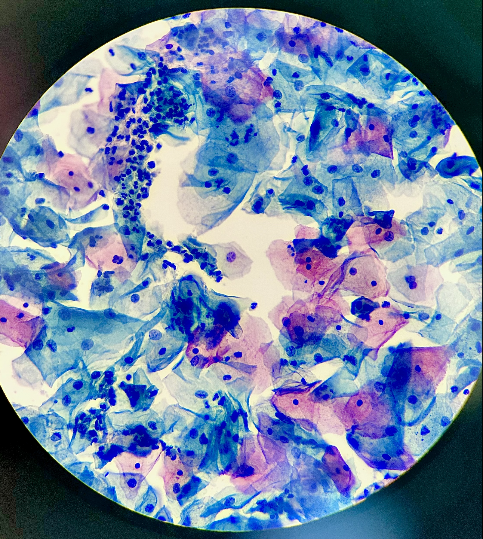 Cellular cytology Pap stain microscopic visualization for cervical cancer screening